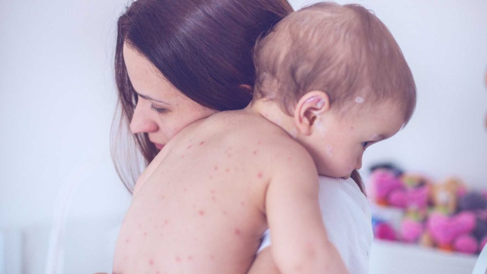 Junior doctors are seeing measles for the first time as cases surge in children