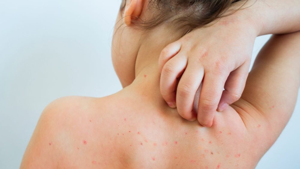 ‘Don’t deliberately infect your child with measles’, doctors tell parents as ‘chickenpox-style parties’ risk lives