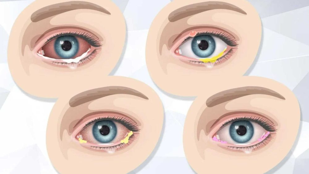 What the colour of your eye ‘sleep’ can reveal about your health – and when to get help