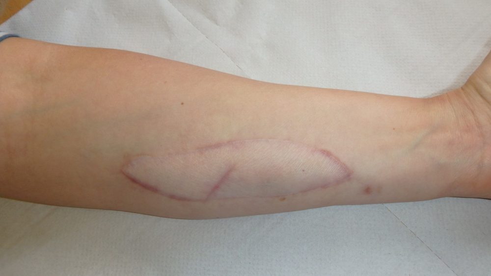 ‘Crucial’ new skin patches that develop into a rash can alert doctors to organ transplant rejection