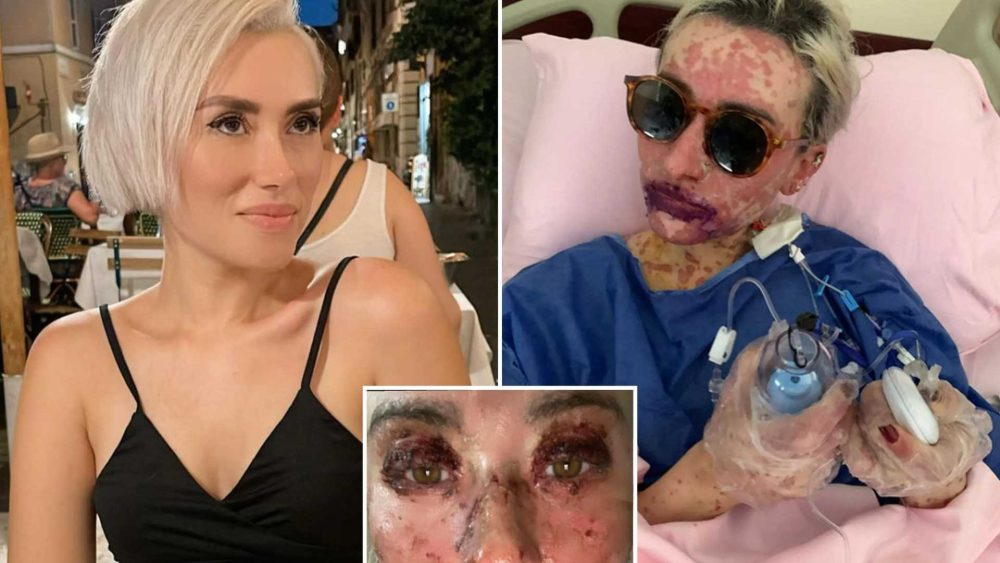 I was burned from the inside out and temporarily blinded after taking drugs to ease my anxiety